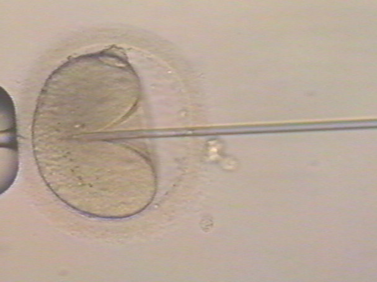 DNA損傷精子である場合の顕微授精と発達障害の関係性