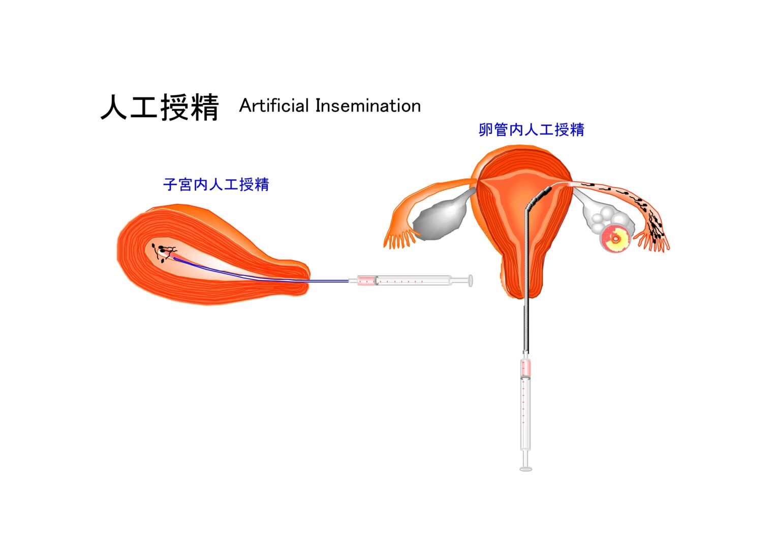人工授精の画像