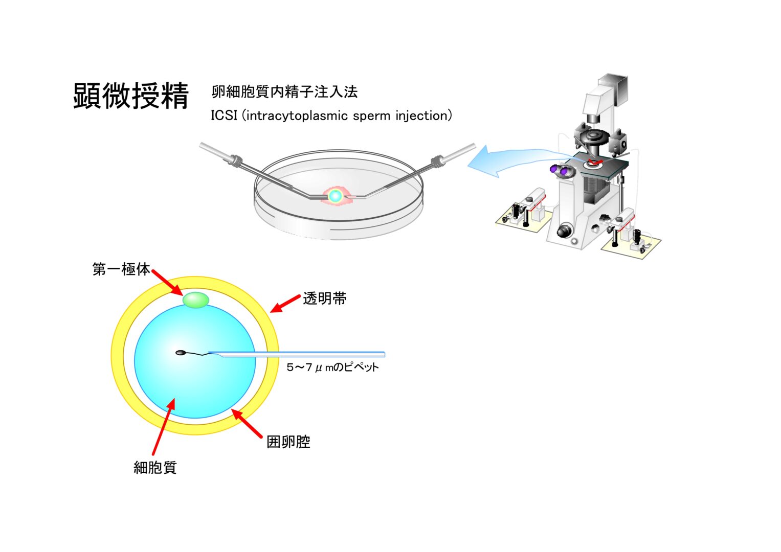 顕微授精の画像
