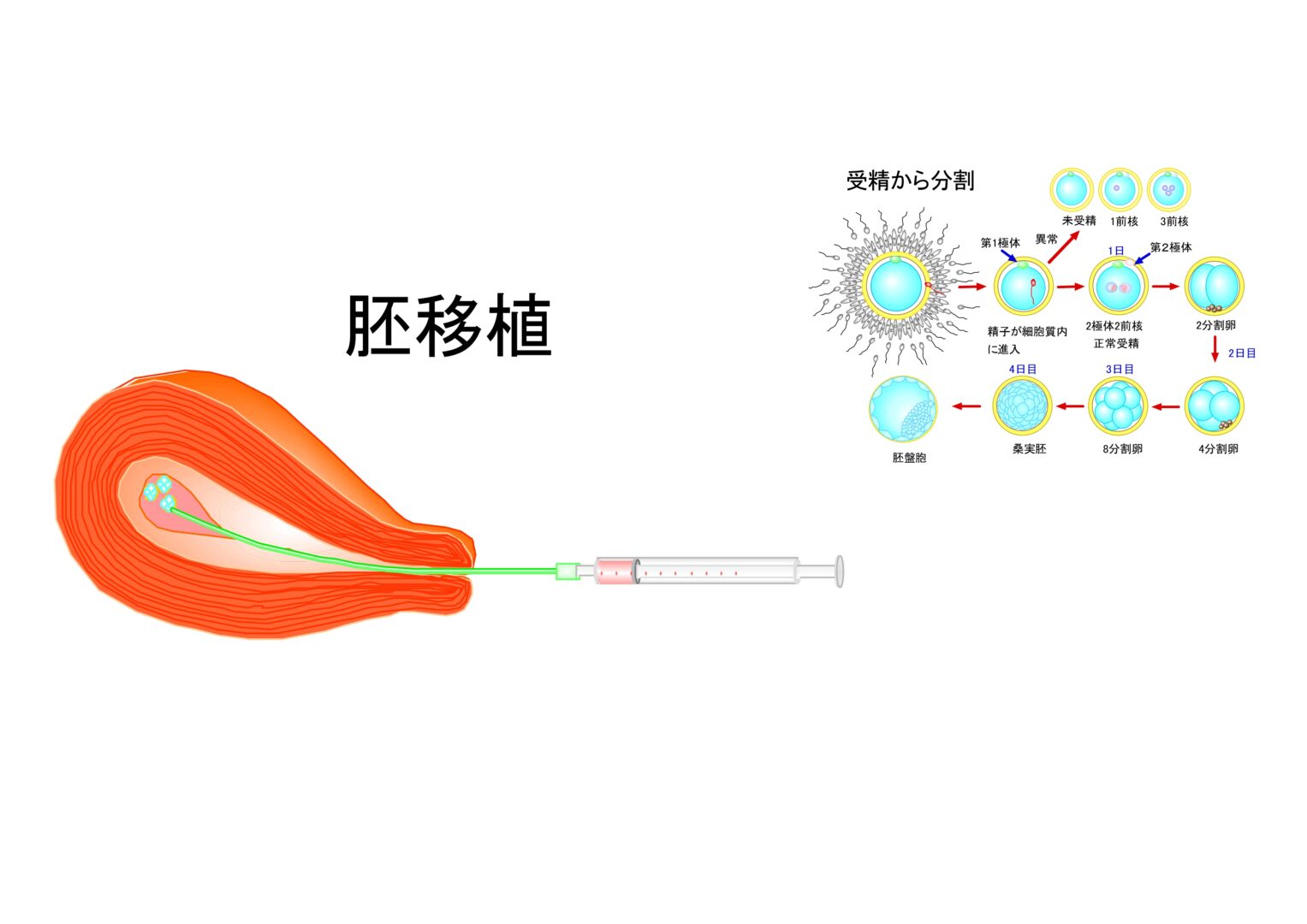 胚移植の画像